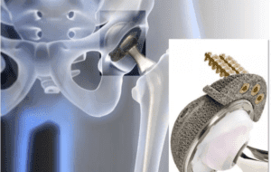 Precision CNC Machining Of Medical Implants